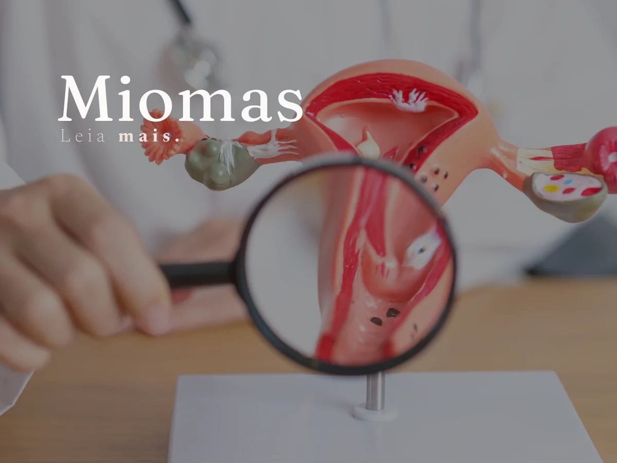 Imagem ilustrativa · Mioma e miomectomia
